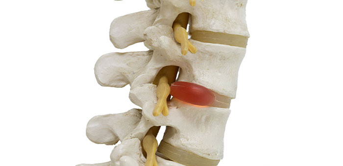 Herniated disc in spine before visiting Denver chiropractor