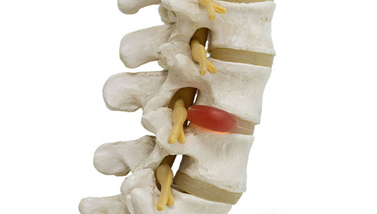 Herniated disc in spine before visiting Denver chiropractor