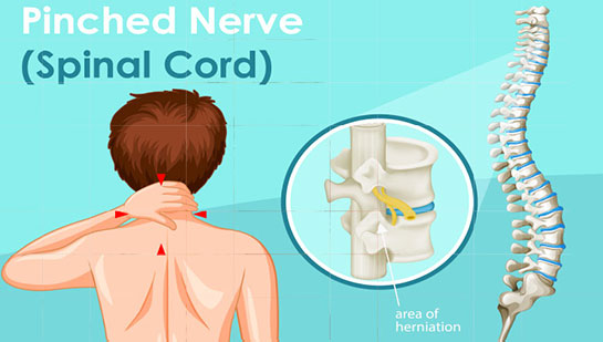 Pinched nerve in spine before chiropractic treatment from Denver chiropractor