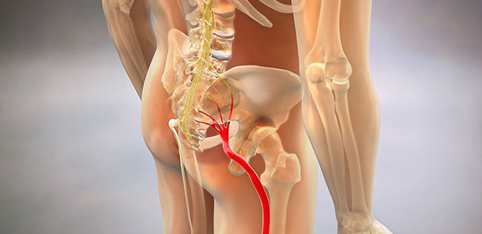 Sciatic nerve pain before chiropractic treatment from Denver chiropractor