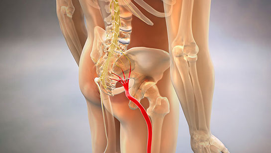 Sciatic nerve pain before chiropractic treatment from Denver chiropractor